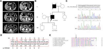 Novel and recurrent genetic variants of VHL, SDHB, and RET genes in Chinese pheochromocytoma and paraganglioma patients